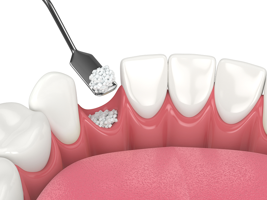 Understanding Bone Grafting: Restoring Oral Health and Enhancing Dental Procedures